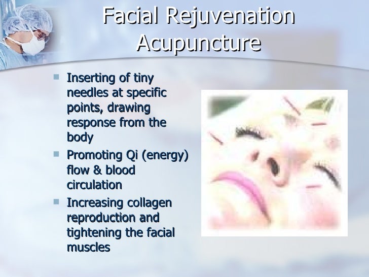 Facial Rejuvenation Acupuncture