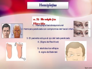 a.2) Hemiplejía
Fláccida
1. Hemiplejíafaciobraquiocrural
2. Hemicaraparalizadacon compromiso del facial inferior
3. El pacienteocluyeel ojo del lado paralizado
4. (Signo deRevilliod)
5. abolidoslosreflejos
6. signo deBabinski
 