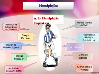 Marcha: Marcha
deToddHemiplejíadel
lado paralizado
con hipertonía
Hiperreflexia
(Reflejos
Policinéticos)
Arreflexia
Clonusdel pie
y rotula
Flexión del
Miembro Superior
Actitud de
Extensión deMS
Rasgos
Faciales
Parálisis
Muscular
Signo de
Babinski
a.3) Hemiplejía
Espástica
 