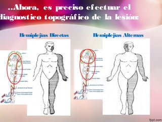 …Ahora, es preciso efectuar el
diagnostico topográfico de la lesión:
Hemiplejías Directas Hemiplejías Alternas
 