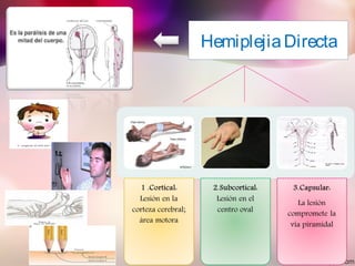 HemiplejiaDirecta
 