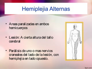 Hemiplejia Alternas
• Areasparalizadasen ambos
hemicuerpos
• Lesión: A ciertaalturadel tallo
cerebral
• Parálisisdeuno o masnervios
cranealesdel lado delalesión, con
hemiplejiaen lado opuesto.
 