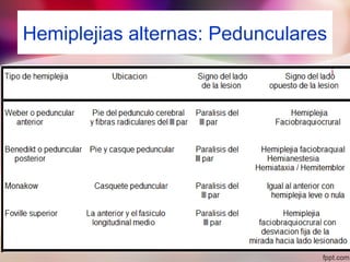 Hemiplejias alternas: Pedunculares
 