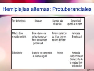 Hemiplejias alternas: Protuberanciales
 