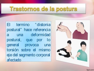El termino “distonia
postural” hace referencia
a una deformidad
postural, que por lo
general provoca una
torsión sobre el mismo
eje del segmento corporal
afectado
 