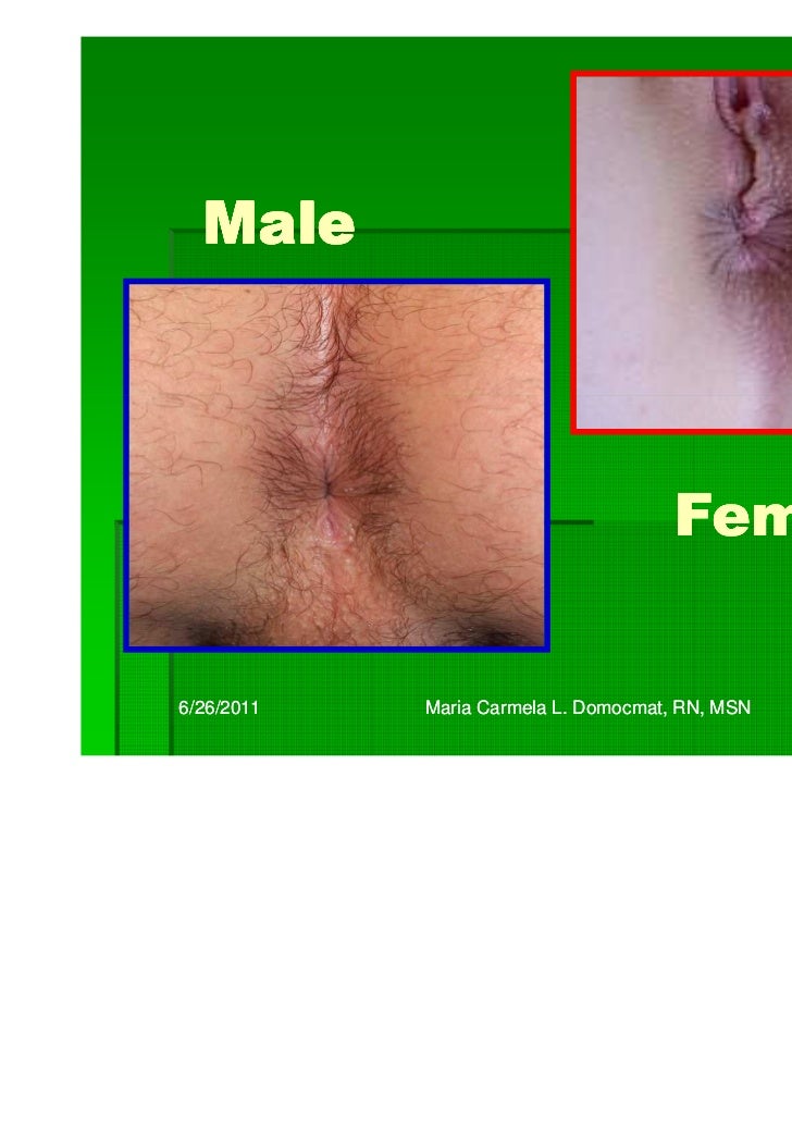 Normal skin tag anus inch Quarter midget mufflers
