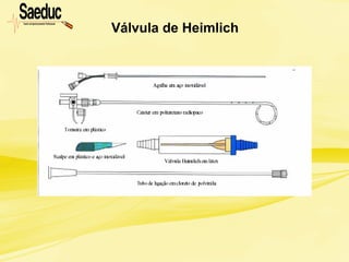 Válvula de Heimlich
 