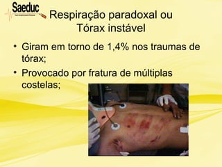Respiração paradoxal ou
Tórax instável
• Giram em torno de 1,4% nos traumas de
tórax;
• Provocado por fratura de múltiplas
costelas;
 