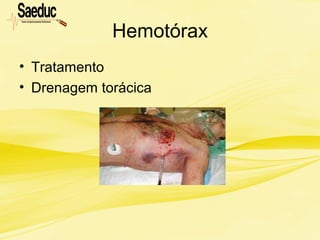 Hemotórax
• Tratamento
• Drenagem torácica
 