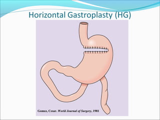 Gomez, Cesar.Gomez, Cesar. World Journal of SurgeryWorld Journal of Surgery, 1981, 1981
 