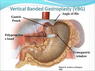 Mason E,Mason E, Archives of SurgeryArchives of Surgery,,
19821982
Polypropylen
e band
Transgastric
window
Angle of His
Gastric
Pouch
 