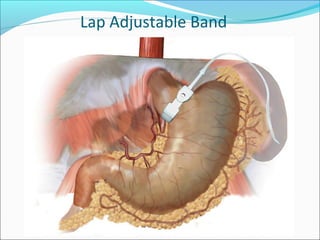 Lap Adjustable Band
 