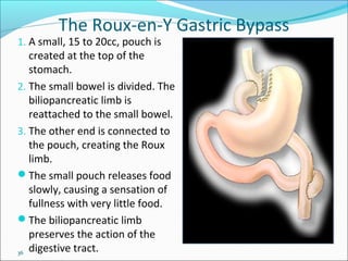 36
The Roux-en-Y Gastric Bypass
1. A small, 15 to 20cc, pouch is
created at the top of the
stomach.
2. The small bowel is divided. The
biliopancreatic limb is
reattached to the small bowel.
3. The other end is connected to
the pouch, creating the Roux
limb.
The small pouch releases food
slowly, causing a sensation of
fullness with very little food.
The biliopancreatic limb
preserves the action of the
digestive tract.
Roux-en-Y Gastric
Bypass
 