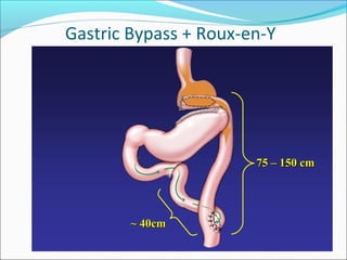 Gastric Bypass + Roux-en-Y
75 – 150 cm75 – 150 cm
~ 40cm~ 40cm
 