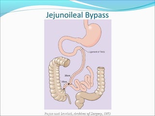 Jejunoileal Bypass
Payne and Dewind,Payne and Dewind, Archives of SurgeryArchives of Surgery, 1973, 1973
 