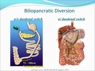 Biliopancratic Diversion
Marceau, et al.Marceau, et al. World Journal of SurgeryWorld Journal of Surgery, 1998, 1998
w/ duodenal switchw/o duodenal switch
75 – 100cm75 – 100cm
Common channelCommon channel
 