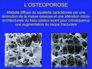 L’OSTEOPOROSE Maladie diffuse du squelette caractérisée par une diminution de la masse osseuse et une altération micro-architecturale du tissu osseux ayant pour conséquence une augmentation du risque fracturaire 