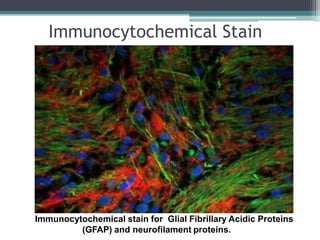 Immunocytochemical stain for Glial Fibrillary Acidic Proteins
(GFAP) and neurofilament proteins.
Immunocytochemical Stain
 