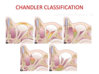 Complications of Sinusitis | PPTX
