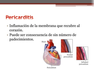 • Inflamación de la membrana que recubre al
corazón.
• Puede ser consecuencia de sin número de
padecimientos.
 