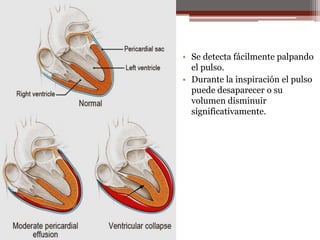 • Se detecta fácilmente palpando
el pulso.
• Durante la inspiración el pulso
puede desaparecer o su
volumen disminuir
significativamente.
 