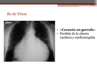 Rx de Tórax
• «Corazón en garrafa»
• Perdida de la silueta
cardiaca y cardiomegalia
 