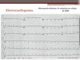 Electrocardiograma
Alternancia eléctrica  variación en voltaje
de QRS
 