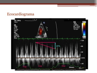 Ecocardiograma
 