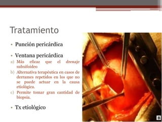 Tratamiento
• Punción pericárdica
• Ventana pericárdica
a) Más eficaz que el drenaje
subxifoideo
b) Alternativa terapéutica en casos de
derrames repetidos en los que no
se puede actuar en la causa
etiológica.
c) Permite tomar gran cantidad de
biopsia.
• Tx etiológico
 