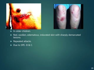  Erysipelas
 In older children.
 Red, swollen, edematous, indurated skin with sharply demarcated
lesions.
 Repeated attacks.
 Due to SPE- B & C.
29
 