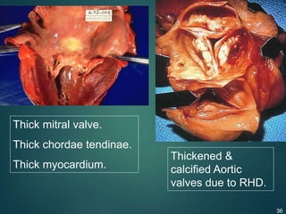 Thick mitral valve.
Thick chordae tendinae.
Thick myocardium.
Thickened &
calcified Aortic
valves due to RHD.
36
 