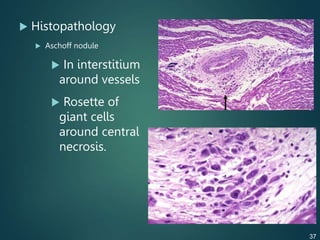  Histopathology
 Aschoff nodule
 In interstitium
around vessels
 Rosette of
giant cells
around central
necrosis.
37
 