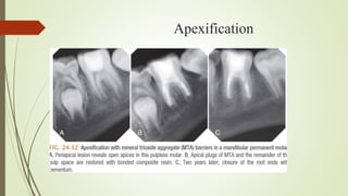 24th oct Pulp Therapy In Young Permanent Teeth.pptx