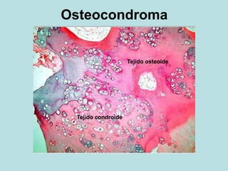 Osteocondroma
Tejido osteoide
Tejido condroide
 