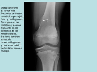 Osteocondroma
El tumor más
frecuente de hueso,
constituido por tejido
óseo y cartilaginoso.
Se origina en las
metáfisis y es más
frecuente en los
extremos de los
huesos largos.
Se llama también
exostosis
osteocartilaginosa
y puede ser sésil o
pediculado, único o
múltiple
 