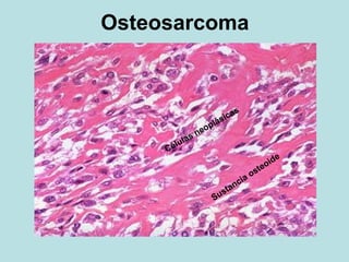 Osteosarcoma
 