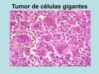 Tumor de células gigantes
 