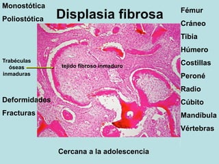 Displasia fibrosa Fémur
Cráneo
Tibia
Húmero
Costillas
Peroné
Radio
Cúbito
Mandíbula
Vértebras
Monostótica
Poliostótica
Deformidades
Fracturas
Cercana a la adolescencia
tejido fibroso inmaduro
Trabéculas
óseas
inmaduras
 