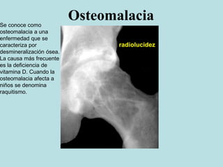 Osteomalacia
radiolucidez
Se conoce como
osteomalacia a una
enfermedad que se
caracteriza por
desmineralización ósea.
La causa más frecuente
es la deficiencia de
vitamina D. Cuando la
osteomalacia afecta a
niños se denomina
raquitismo.
 
