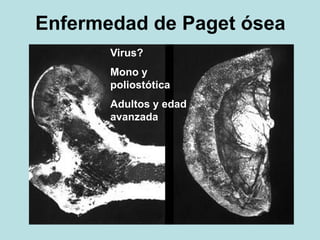 Enfermedad de Paget ósea
Virus?
Mono y
poliostótica
Adultos y edad
avanzada
 
