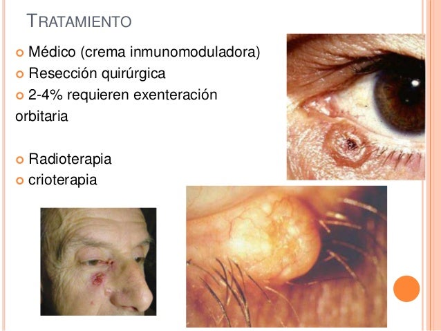 El Cancer En Ancianos Es Mas Lento
