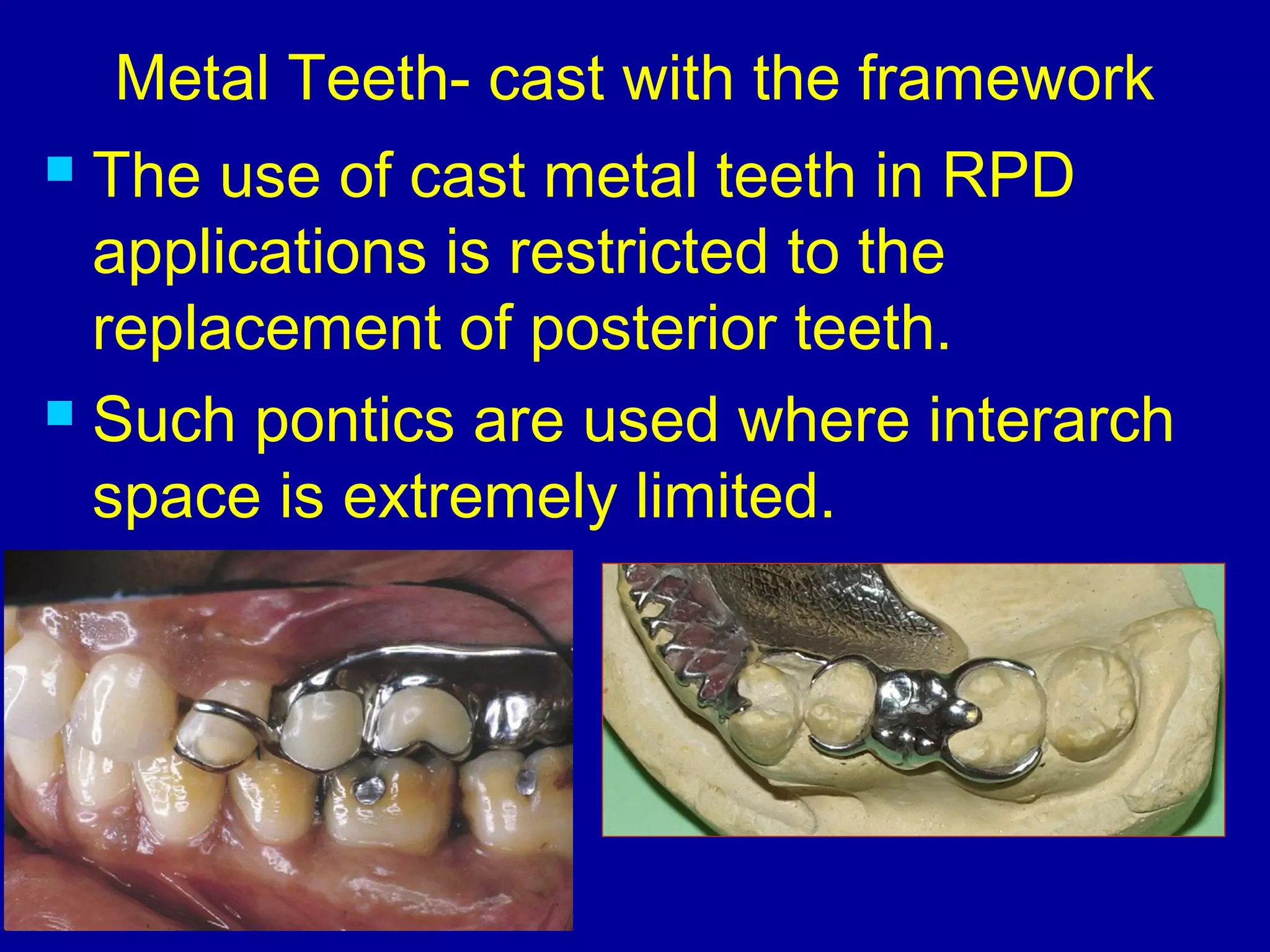 Metal Teeth- cast with the framework
 The use of cast metal teeth in RPD
applications is restricted to the
replacement of posterior teeth.
 Such pontics are used where interarch
space is extremely limited.
 