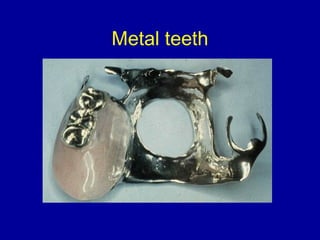 Metal Base Rpd Single Tooth 25. rpd denture bases+teeth | PPT