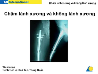 Chậm lành xương và không lành xương
Chậm lành xương và không lành xương
Wu xinbao
Bệnh viện Ji Shui Tan, Trung Quốc
 