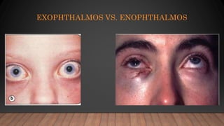 EXOPHTHALMOS VS. ENOPHTHALMOS
 