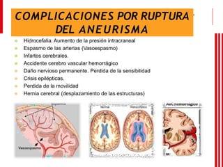 Enfermería
Pregrado
COMPLICACIONES POR RUPTURA
DEL ANEURISMA
⦿ Hidrocefalia. Aumento de la presión intracraneal
⦿ Espasmo de las arterias (Vasoespasmo)
⦿ Infartos cerebrales.
⦿ Accidente cerebro vascular hemorrágico
⦿ Daño nervioso permanente. Perdida de la sensibilidad
⦿ Crisis epilépticas.
⦿ Perdida de la movilidad
⦿ Hernia cerebral (desplazamiento de las estructuras)
 