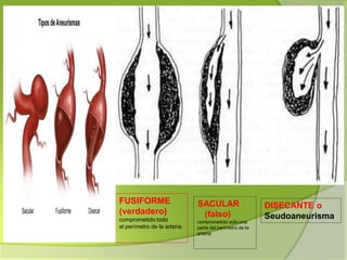 Enfermería
Pregrado
FUSIFORME
(verdadero)
comprometido todo
el perímetro de la arteria.
SACULAR
(falso)
comprometido solo una
parte del perímetro de la
arteria
DISECANTE o
Seudoaneurisma
 