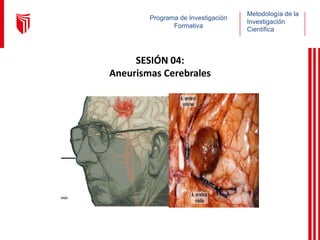 Metodología de la
Investigación
Científica
Programa de Investigación
Formativa
SESIÓN 04:
Aneurismas Cerebrales
 