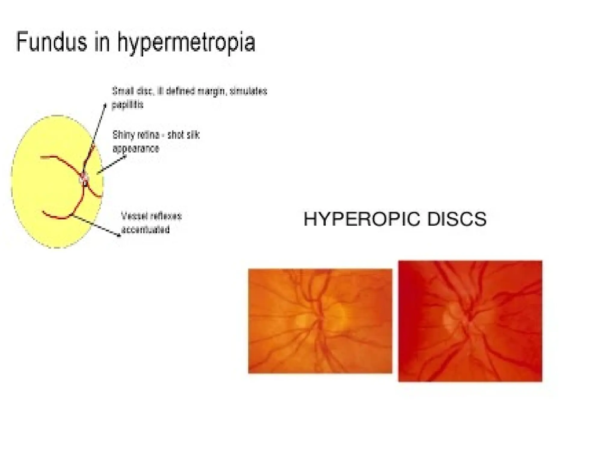 25. hypermetropia ophthalmology-Dr RAHUL.pptx