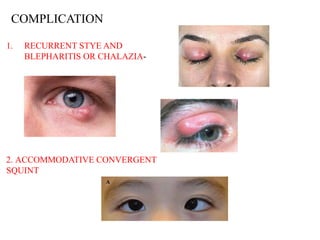 Preventing Stye Recurrence 25. hypermetropia ophthalmology-Dr RAHUL.pptx